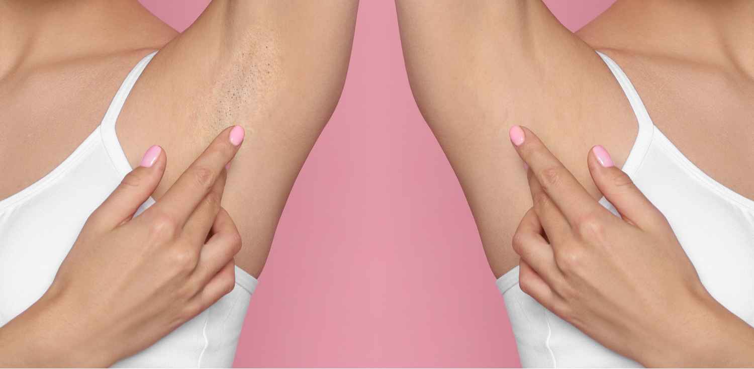 To Shave, To Wax, Or To Laser? | Manhattan Laser Spa