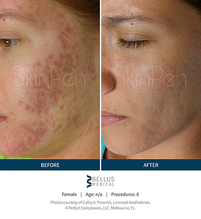 Before & after_image_Microneedling NYC-service-page_manhattanlaserspa-one