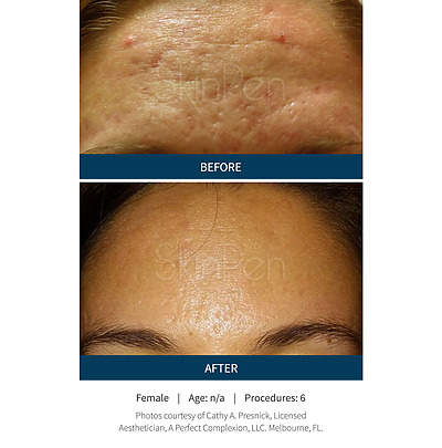 Before & after_image_Microneedling NYC-service-page_manhattanlaserspa-three