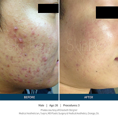 Before & after_image_Microneedling NYC-service-page_manhattanlaserspa-two