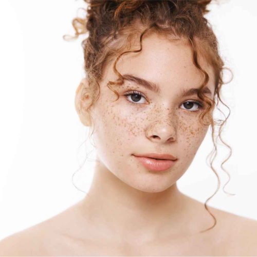 Young Lady with age spots Sunspot freckles on face | Manhattan Laser Spa in NYC