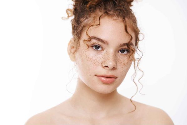 Young Lady with age spots Sunspot freckles on face | Manhattan Laser Spa in NYC