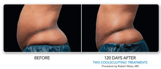 Coolsculpting-Elite-Manhattan Laser Spa NYC-Before-After