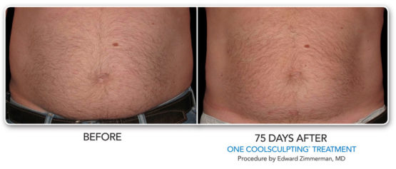 Coolsculpting-Elite-NYC-Before-After-Manhattan laser Spa