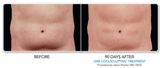 Coolsculpting-Elite-NYC-Before-After-Manhattan laserSpa