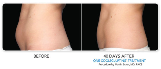Coolsculpting-Elite-NYC-Manhattan Laser Spa Before-After