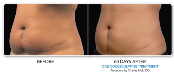 Coolsculpting-Elite-NYC-Manhattan Laser Spa Before and After