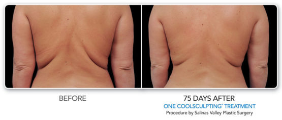 Coolsculpting-Elite-NYC-Manhattan laser Spa Before or After
