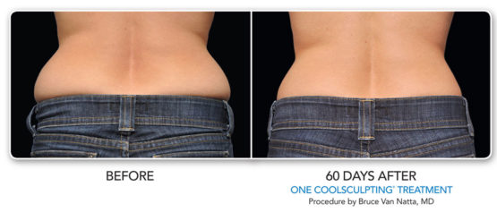 Manhattan laser Spa Coolsculpting-Elite-NYC-After or Before