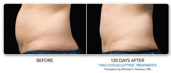 Manhattan laser Spa Coolsculpting-Elite-NYC-Before-After