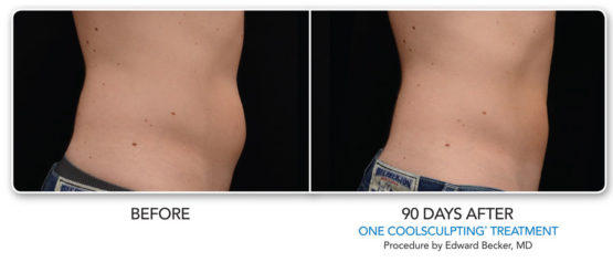 Manhattan laser Spa Coolsculpting-EliteNYC-Before-After