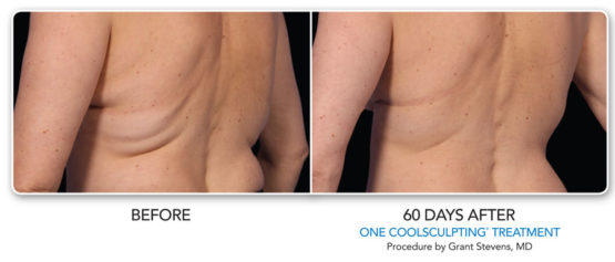 Manhattan laserSpa Coolsculpting-Elite-NYC-Before-After