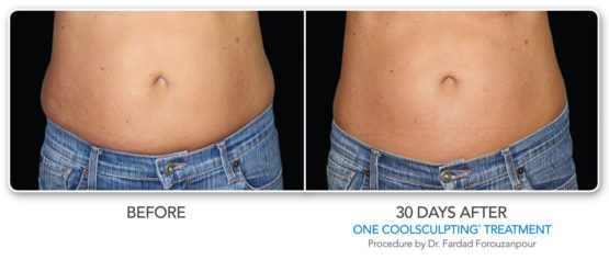 Manhattanlaser Spa Coolsculpting-Elite-NYC-Before-After