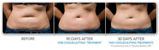 ManhattanlaserSpa Coolsculpting-Elite-NYC-Before-After