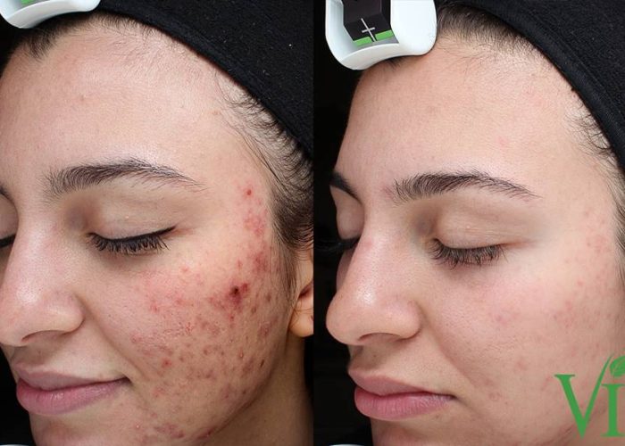 Acne-and-Acne-Scarring_Before & After_Images_VI Peel-service_manhattanlaserspa