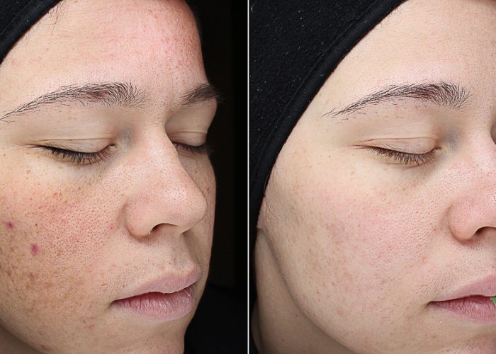Acne_Before & After_Images_VI Peel-service_manhattanlaserspa