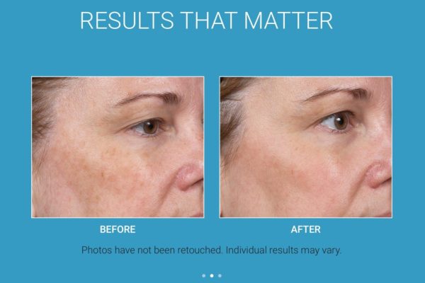 Before & After_Clear + Brilliant® Laser-service_images_manhattanlaserspa-one