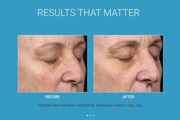 Before & After_Clear + Brilliant® Laser-service_images_manhattanlaserspa-three