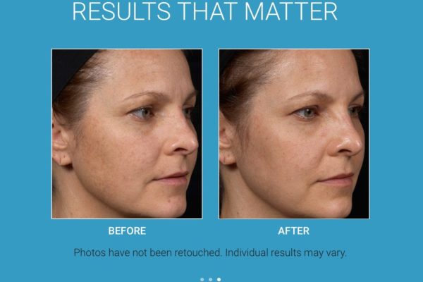 Before & After_Clear + Brilliant® Laser-service_images_manhattanlaserspa-two