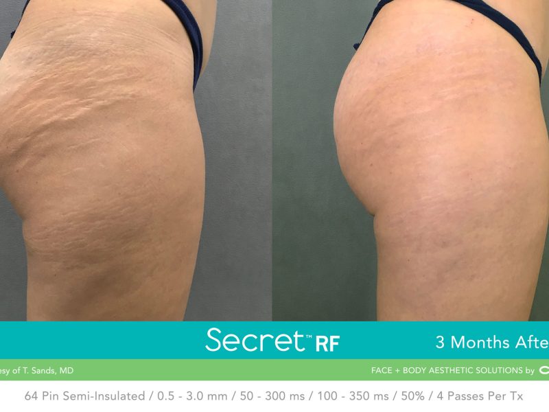 Before-&-After_Images_RF-Microneedling-service_manhattanlaserspa-five