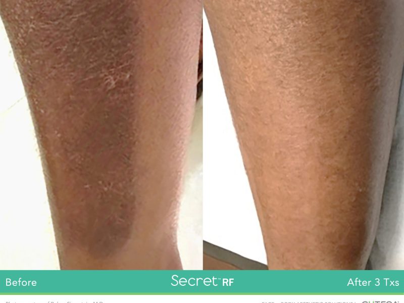 Before-&-After_Images_RF-Microneedling-service_manhattanlaserspa-four