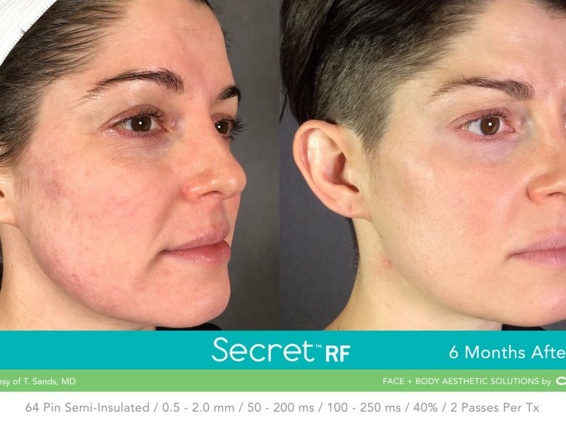 Before-&-After_Images_RF-Microneedling-service_manhattanlaserspa