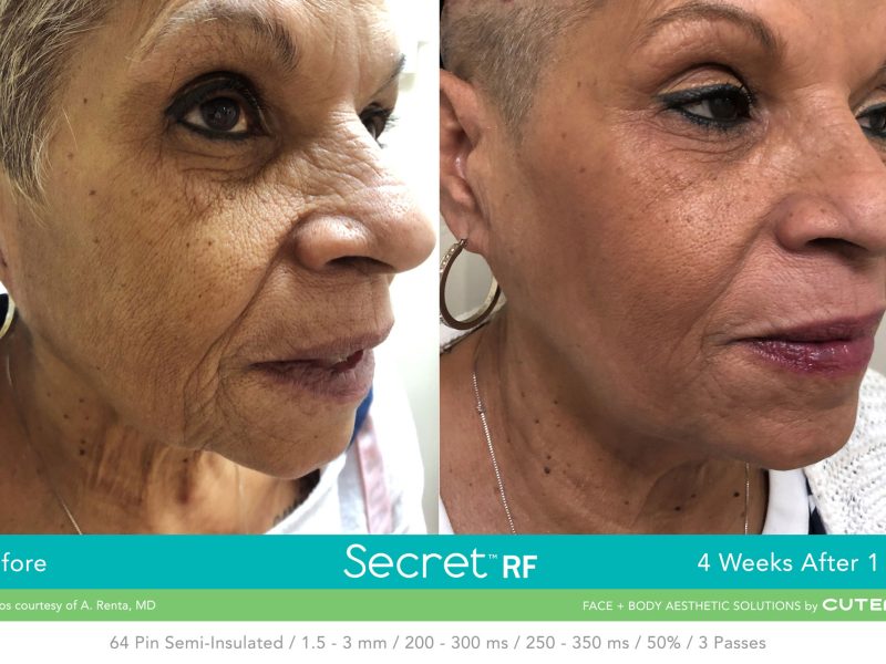 Before-&-After_Images_RF-Microneedling-service_manhattanlaserspa-three