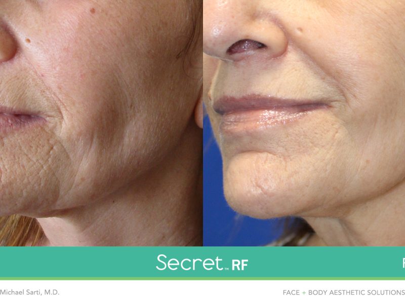 _Before & After_Images_RF Microneedling-service_manhattanlaserspa-two