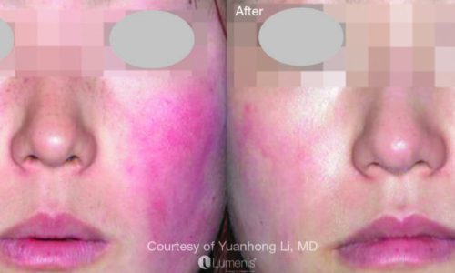 Before & After_The Lumenis® M22 IPL-service_images_manhattanlaserspa-one