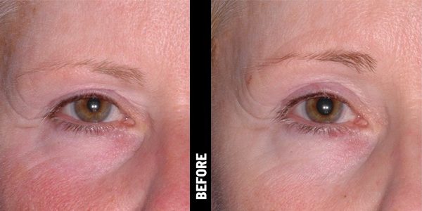 Before & After_Ultherapy-service_images_manhattanlaserspa-four
