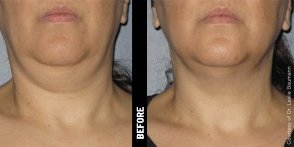 Before & After_Ultherapy-service_images_manhattanlaserspa-one