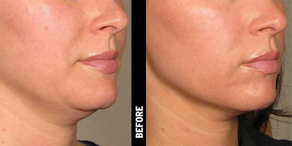 Before & After_Ultherapy-service_images_manhattanlaserspa-three