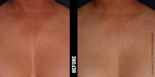 Before & After_Ultherapy-service_images_manhattanlaserspa-two