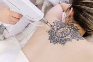 Laser Tattoo Removal NYC What Is the Treatment Like Manhattan Laser Spa