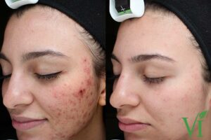Acne and Acne Scarring Before After Images VI Peel service manhattanlaserspa