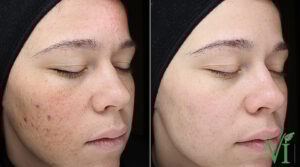 Acne Before After Images VI Peel service manhattanlaserspa