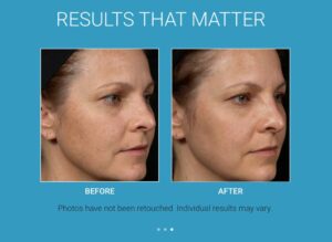 Chemical Peels in Hallandale Beach, FL 2 Before After Clear Brilliant® Laser service images manhattanlaserspa two