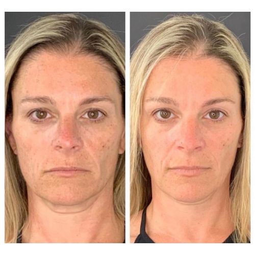 Before & After_images_jetpeel_Manhattanlaserspa-five