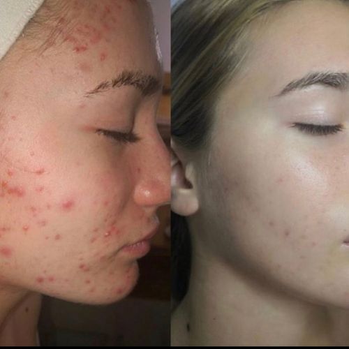 Before & After_images_jetpeel_Manhattanlaserspa-four