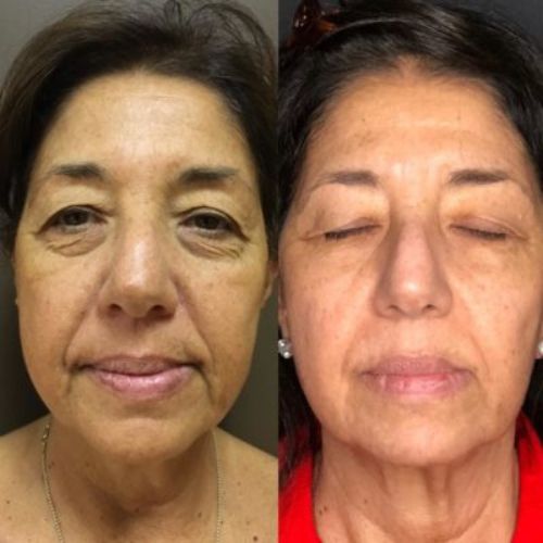 Before & After_images_jetpeel_Manhattanlaserspa-one