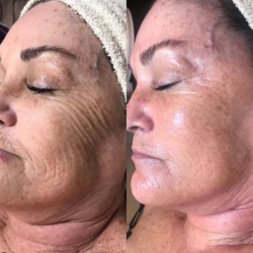 Before & After_images_jetpeel_Manhattanlaserspa-three