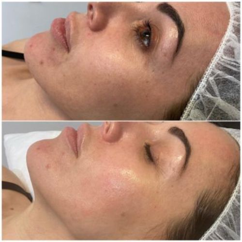 Before & After_images_jetpeel_Manhattanlaserspa-two