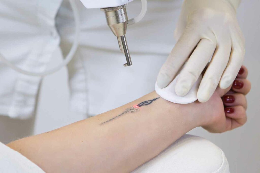 Portfolio 8 Laser tattoo Removal manhattan laser spa NYC