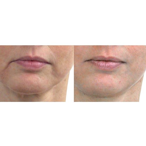 Lips_43-ans_12_sessions_Endermolift_manhattan-laser-spa-