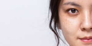 Young Lady side face photo with Sunspot: age spot freckles on face | Manhattan Laser Spa in NYC