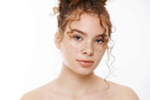 Young Lady with age spots Sunspot freckles on face | Manhattan Laser Spa in NYC