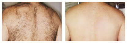 Laser Hair Removal in Miami, Sunny Isles Beach