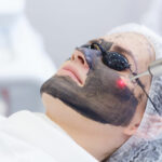 Carbon Laser Facial – 1 session