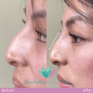 Dark Spot Treatment in Hollywood, FL 1 BA Nose Filler manhattan laser spa