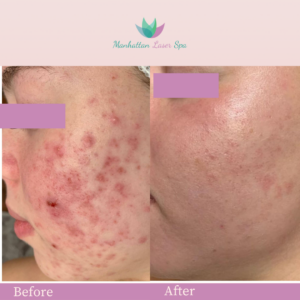 Acne Removal florida images after before manhattan laser spa